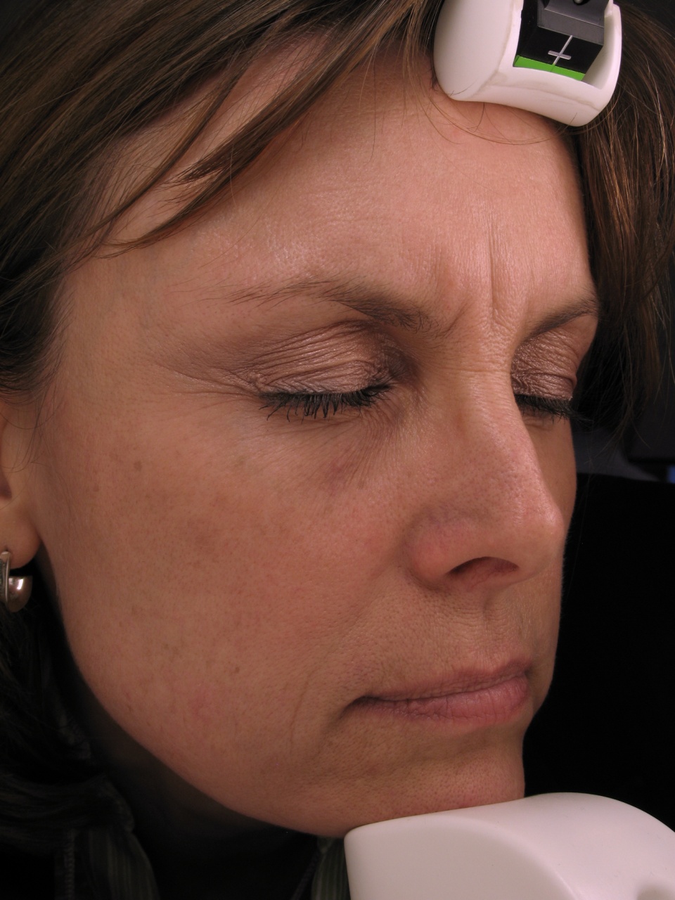 Collagen Stimulation Therapy Before Photo